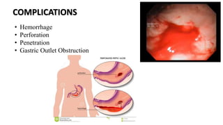 COMPLICATIONS
• Hemorrhage
• Perforation
• Penetration
• Gastric Outlet Obstruction
 