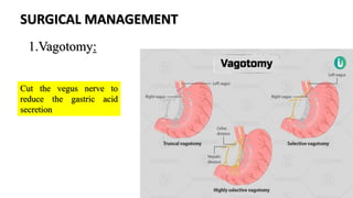 SURGICAL MANAGEMENT
1.Vagotomy:
Cut the vegus nerve to
reduce the gastric acid
secretion
 