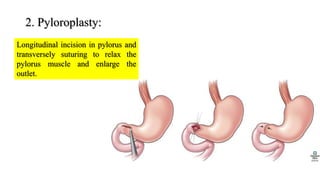 2. Pyloroplasty:
Longitudinal incision in pylorus and
transversely suturing to relax the
pylorus muscle and enlarge the
outlet.
 