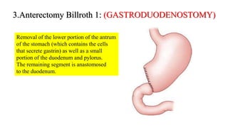 3.Anterectomy Billroth 1: (GASTRODUODENOSTOMY)
Removal of the lower portion of the antrum
of the stomach (which contains the cells
that secrete gastrin) as well as a small
portion of the duodenum and pylorus.
The remaining segment is anastomosed
to the duodenum.
 