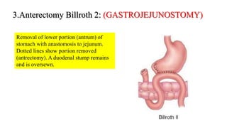 3.Anterectomy Billroth 2: (GASTROJEJUNOSTOMY)
Removal of lower portion (antrum) of
stomach with anastomosis to jejunum.
Dotted lines show portion removed
(antrectomy). A duodenal stump remains
and is oversewn.
 