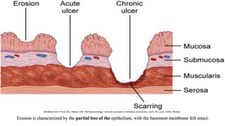 Erosion is characterized by the partial loss of the epithelium, with the basement membrane left intact.
 