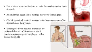 • Peptic ulcers are more likely to occur in the duodenum than in the
stomach.
• As a rule they occur alone, but they may occur in multiples.
• Chronic gastric ulcers tend to occur in the lesser curvature of the
stomach, near the pylorus.
• Esophageal ulcers occur as a result of the
backward flow of HCl from the stomach
into the esophagus (gastroesophageal reflux
disease [GERD]).
 