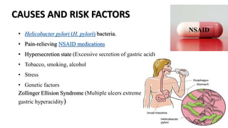 CAUSES AND RISK FACTORS
• Helicobacter pylori (H. pylori) bacteria.
• Pain-relieving NSAID medications
• Hypersecretion state (Excessive secretion of gastric acid)
• Tobacco, smoking, alcohol
• Stress
• Genetic factors
Zollinger Ellision Syndrome (Multiple ulcers extreme
gastric hyperacidity)
 