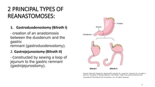 Peptic Ulcer Disease.pptx