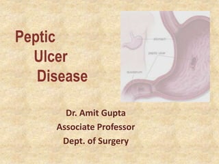 Peptic
Ulcer
Disease
Dr. Amit Gupta
Associate Professor
Dept. of Surgery
 