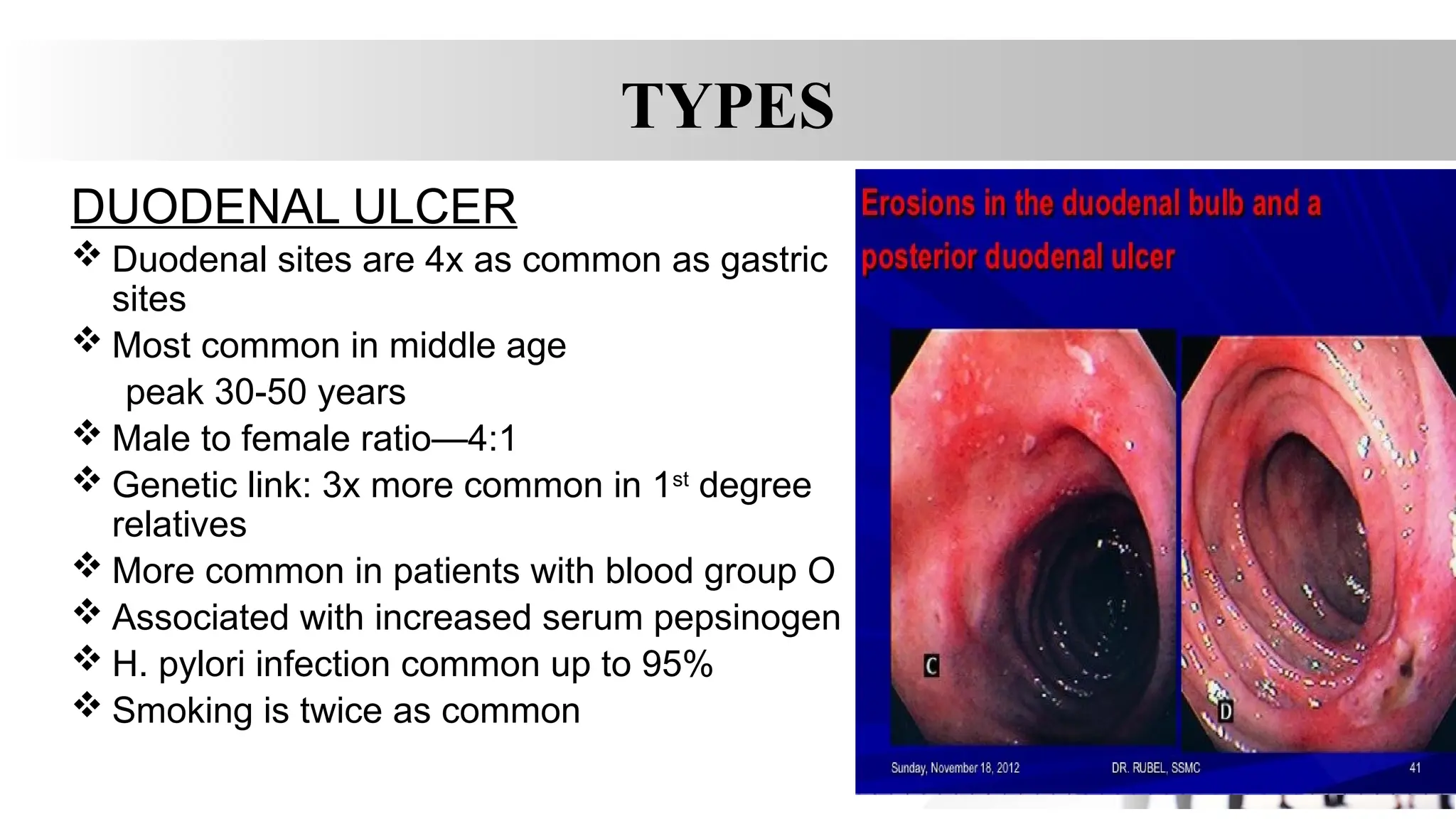 TYPES
DUODENAL ULCER
 Duodenal sites are 4x as common as gastric
sites
 Most common in middle age
peak 30-50 years
 Male to female ratio—4:1
 Genetic link: 3x more common in 1st
degree
relatives
 More common in patients with blood group O
 Associated with increased serum pepsinogen
 H. pylori infection common up to 95%
 Smoking is twice as common
 