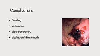 comprehensive-overview-of-peptic-ulcer-disease-causes-diagnosis-and