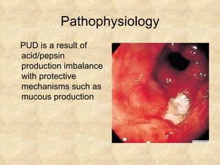 Pathophysiology PUD is a result of acid/pepsin production imbalance with protective mechanisms such as mucous production 