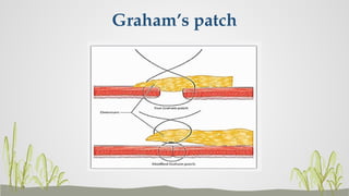 Graham's Patch PEPTIC ULCER DISEASE (PUD) | PPTX