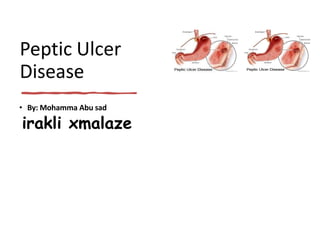 Peptic Ulcer
Disease
• By: Mohamma Abu sad
irakli xmalaze
 