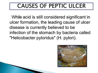 While acid is still considered significant in
ulcer formation, the leading cause of ulcer
disease is currently believed to be
infection of the stomach by bacteria called
"Helicobacter pyloridus" (H. pylori).
 
