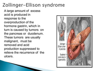A large amount of excess
acid is produced in
response to the
overproduction of the
hormone gastrin, which in
turn is caused by tumors on
the pancreas or duodenum.
These tumors are usually
malignant, must be
removed and acid
production suppressed to
relieve the recurrence of the
ulcers.
 