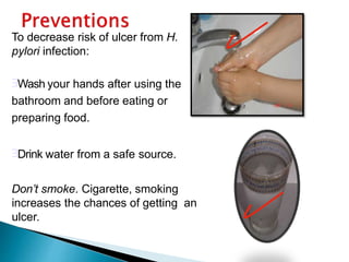 To decrease risk of ulcer from H.
pylori infection:
Wash your hands after using the
bathroom and before eating or
preparing food.
Drink water from a safe source.
Don’t smoke. Cigarette, smoking
increases the chances of getting an
ulcer.
 