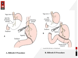 A. Billroth I Procedure B. Billroth II Procedure
 