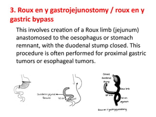Edge Procedure Rouex Peptic_Ulcers_Detailed_Seminar_Presentation.pptx