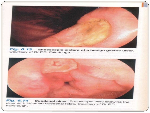Sucralfate (Carafate) A Pepsin Inhibitor Acts By