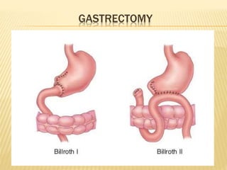 GASTRECTOMY
 