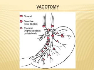 VAGOTOMY
 