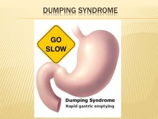 DUMPING SYNDROME
 