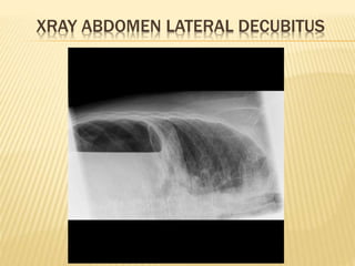 XRAY ABDOMEN LATERAL DECUBITUS
 
