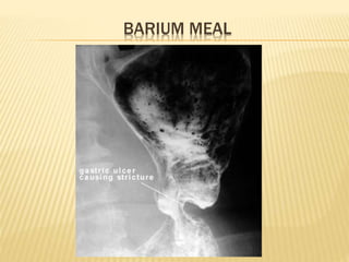 BARIUM MEAL
 