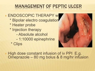 MANAGEMENT OF PEPTIC ULCER
 ENDOSCOPIC THERAPY with
* Bipolar electro coagulation
* Heater probe
* Injection therapy
- Absolute alcohol
- 1:10000 epinephrine
* Clips
 High dose constant infusion of iv PPI E.g.
Omeprazole – 80 mg bolus & 8 mg/hr infusion
 
