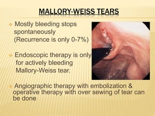 MALLORY-WEISS TEARS
 Mostly bleeding stops
spontaneously
(Recurrence is only 0-7%)
 Endoscopic therapy is only
for actively bleeding
Mallory-Weiss tear.
 Angiographic therapy with embolization &
operative therapy with over sewing of tear can
be done
 