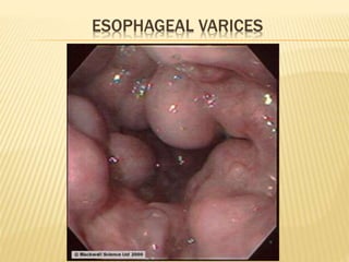 ESOPHAGEAL VARICES
 