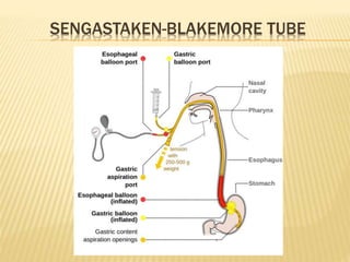 SENGASTAKEN-BLAKEMORE TUBE
 