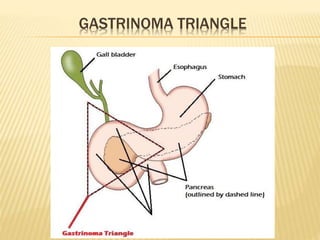 GASTRINOMA TRIANGLE
 