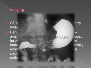  CT performed for abdominal pain can identify
non-perforated peptic ulcers.
 Barium radiography is infrequently used →
availability of EGD which enables us to biopsy
for H. pylori testing and histopathology. On
barium radiography, an ulcer niche is generally
round or oval and may be surrounded by a
smooth mound of edema. It requires
radiographer expertise.
 