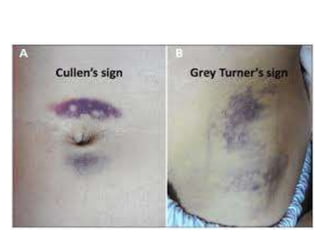 Thomas's Sign Per abdomen examination - Clinical Methods - Abdomen | PPTX