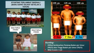 2
105 cm 125 cm 100 cm
7 thn 7 thn 4 thn
Stunting:
• Dilihat berdasarkan Panjang Badan per Umur
(PB/U) atau Tinggi Badan per Umur (TB/U).
• Nilai Z-score <-2,0
Usia 4 tahun
4 bulan
Usia 2 tahun
2 bulan
STUNTING TERLAMBAT DIKENALI
(BARU DAPAT DILIHAT SETELAH 2
TAHUN)
 