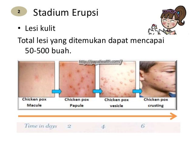 GEJALA KLINIS CACAR AIR