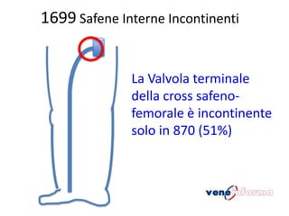1699 Safene Interne Incontinenti

La Valvola terminale
della cross safenofemorale è incontinente
solo in 870 (51%)

 