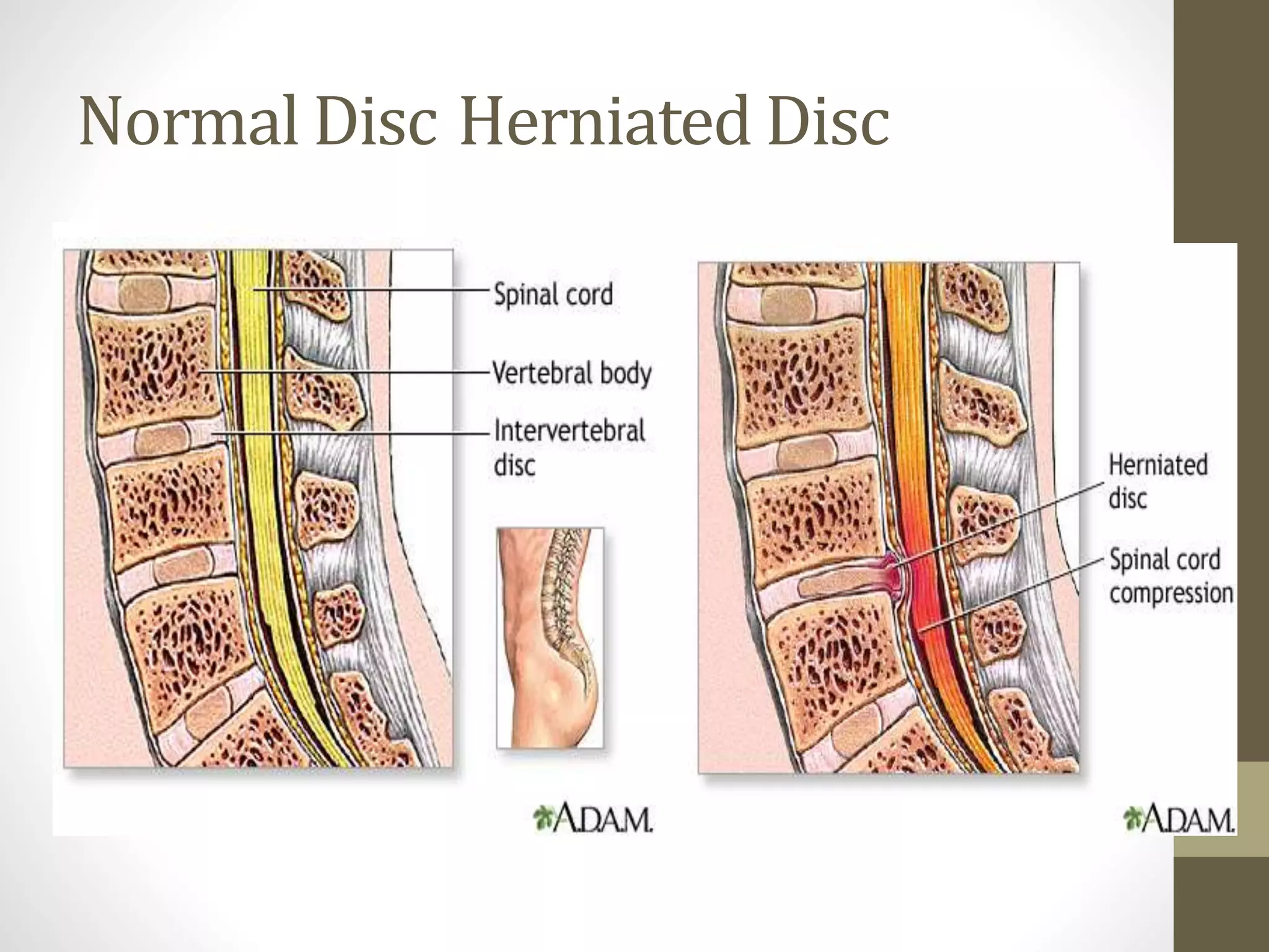 Normal Disc Herniated Disc
 
