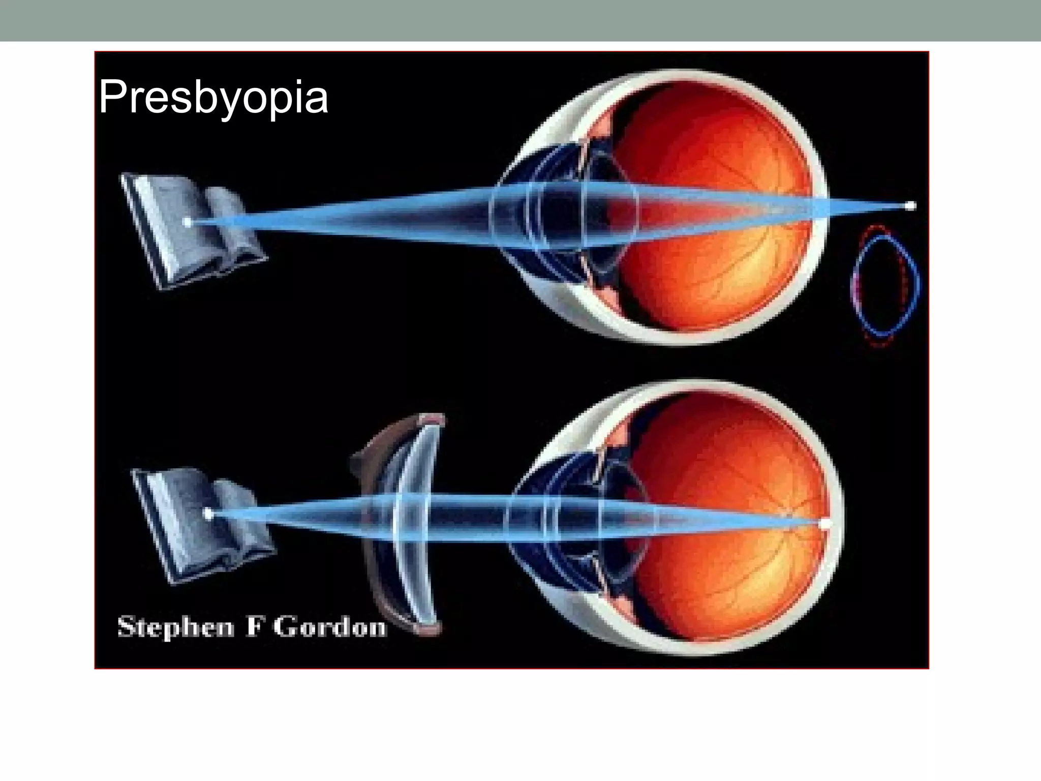 Presbyopia 