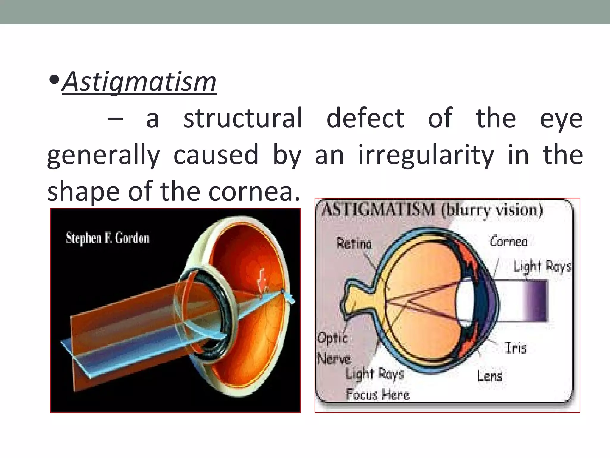 Astigmatism   –  a structural defect of the eye generally caused by an irregularity in the shape of the cornea.  