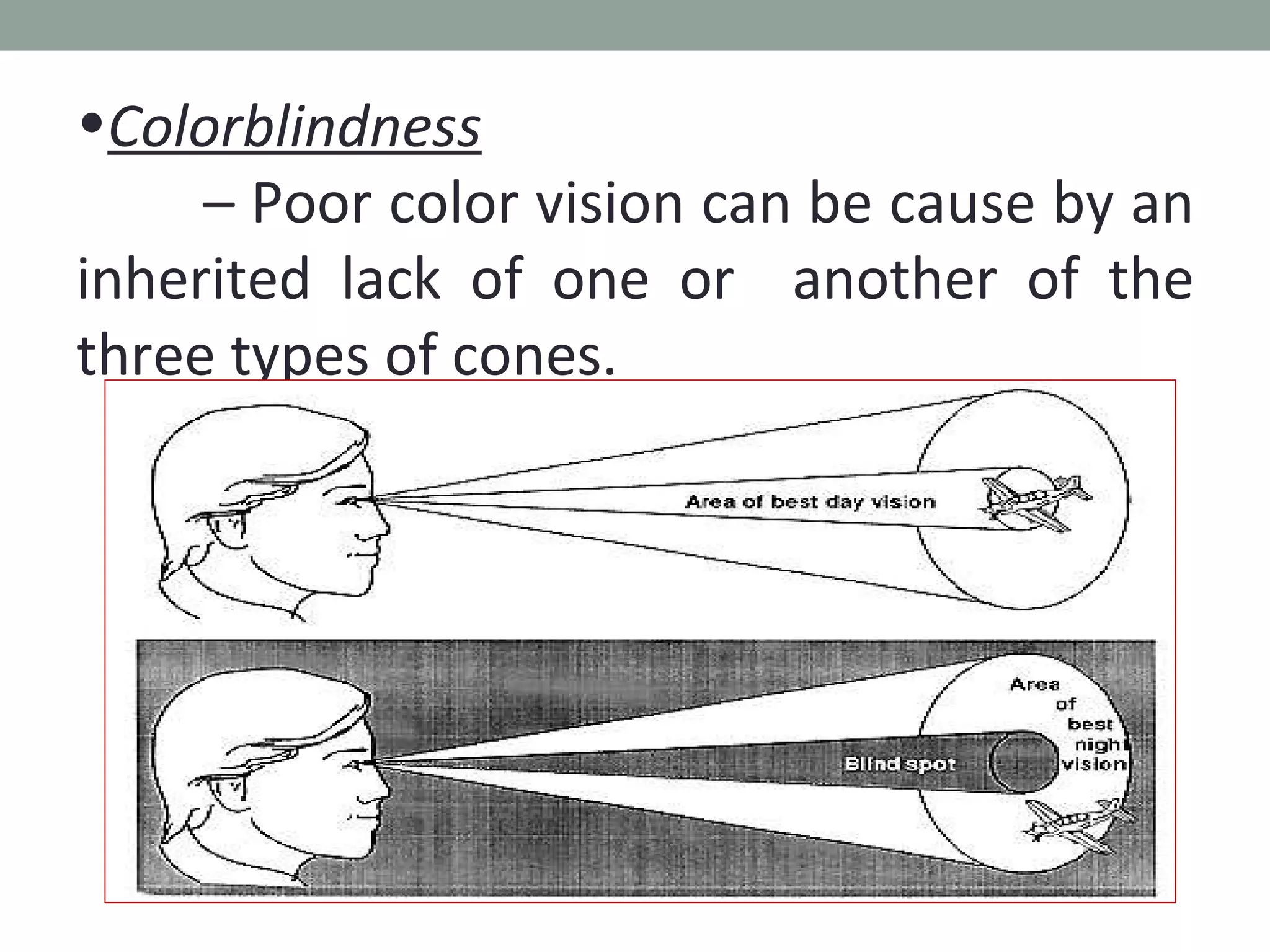Colorblindness   –  Poor color vision can be cause by an inherited lack of one or  another of the three types of cones. 