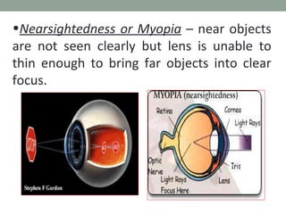 <ul><li>Nearsightedness or Myopia  – near objects are not seen clearly but lens is unable to thin enough to bring far obje...