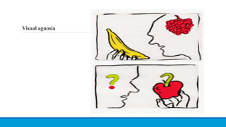 Visual agnosia
 