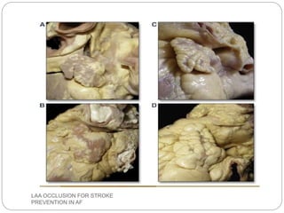 LAA OCCLUSION FOR STROKE
PREVENTION IN AF
 