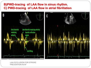 B)PWD-tracing of LAA flow in sinus rhythm.
C) PWD-tracing of LAA flow in atrial fibrillation.
LAA OCCLUSION FOR STROKE
PREVENTION IN AF
 