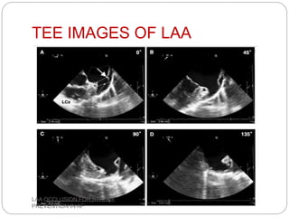 TEE IMAGES OF LAA
LAA OCCLUSION FOR STROKE
PREVENTION IN AF
 