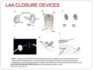 LAA CLOSURE DEVICES
LAA OCCLUSION FOR STROKE
PREVENTION IN AF
 