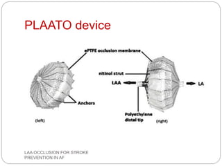 PLAATO device
LAA OCCLUSION FOR STROKE
PREVENTION IN AF
 