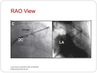 RAO View
LAA OCCLUSION FOR STROKE
PREVENTION IN AF
 