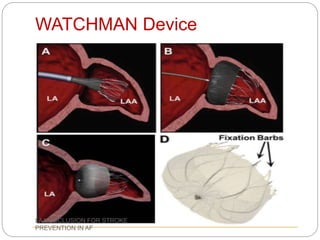 WATCHMAN Device
LAA OCCLUSION FOR STROKE
PREVENTION IN AF
 