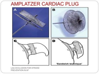 AMPLATZER CARDIAC PLUG
LAA OCCLUSION FOR STROKE
PREVENTION IN AF
 